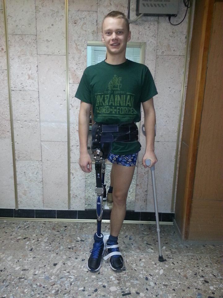 Впервые в Украине изготовили современные протезы нижних конечностей (Фото)
