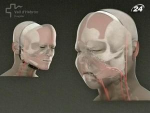 В Іспанії провели першу у світі повну трансплантацію обличчя В Іспанії провели першу у світі повну трансплантацію обличчя