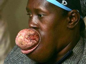 Гаїтянці видалили з рота двокілограмову пухлину Гаїтянці видалили з рота двокілограмову пухлину