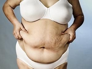 Вчені: знищувати жир ефективніше за допомогою холоду, а не тепла Вчені: знищувати жир ефективніше за допомогою холоду, а не тепла