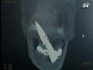 Китаєць 4 роки жив з ножем у голові і нічого не підозрював Китаєць 4 роки жив з ножем у голові і нічого не підозрював