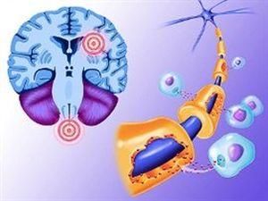 Вчені: Розсіяний склероз можна зупинити Вчені: Розсіяний склероз можна зупинити