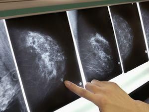 Щогодини від раку молочної залози помирає жінка