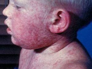 На Волыни у 10 детей диагностировали корь На Волыни у 10 детей диагностировали корь