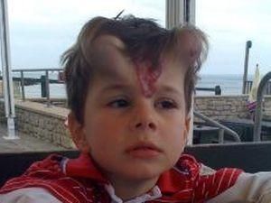 Маленькому хлопчику ввели імплантанти у вигляді рогів Маленькому хлопчику ввели імплантанти у вигляді рогів