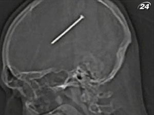 Американець більше доби проходив з цвяхом у голові Американець більше доби проходив з цвяхом у голові