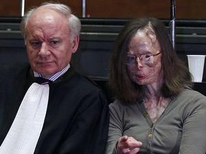 Жінка подала до суду на свого коханця, який облив її обличчя кислотою Жінка подала до суду на свого коханця, який облив її обличчя кислотою