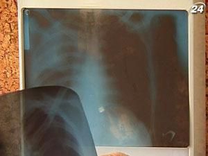 Хворих на туберкульоз тепер можуть ув’язнити Хворих на туберкульоз тепер можуть ув’язнити