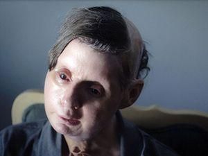 Женщина, которой пересадили "новое лицо", почти полностью выздоровела Женщина, которой пересадили "новое лицо", почти полностью выздоровела