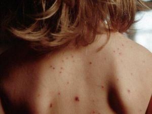 За сутки в Украине зарегистрировано 95 случаев кори За сутки в Украине зарегистрировано 95 случаев кори