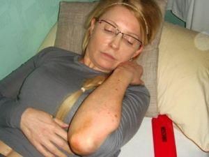 ГПтС: Гематомы на теле Тимошенко появляются периодически ГПтС: Гематомы на теле Тимошенко появляются периодически