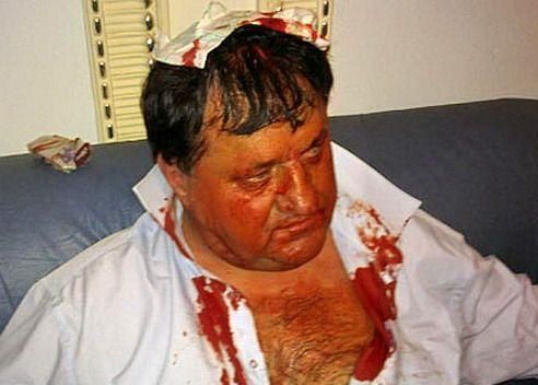 У побитого БЮТівця струс мозку У побитого БЮТівця струс мозку