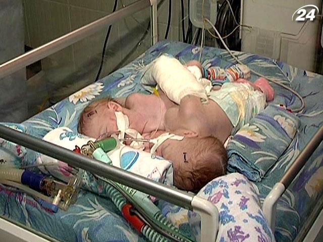 Жизнь донецких сиамских близнецов в руках врачей