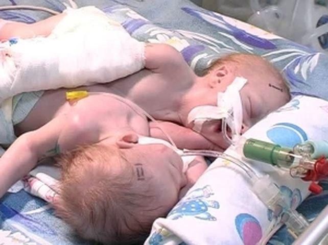 Донецких сиамских близнецов разделить не удастся Донецких сиамских близнецов разделить не удастся