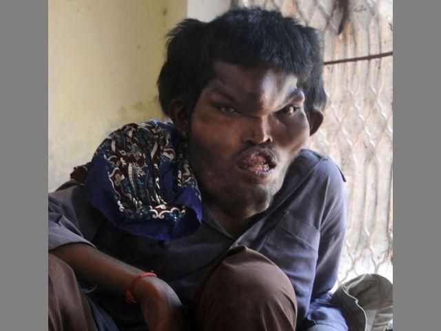 У Пакистані живе "Людина-слон" У Пакистані живе "Людина-слон"