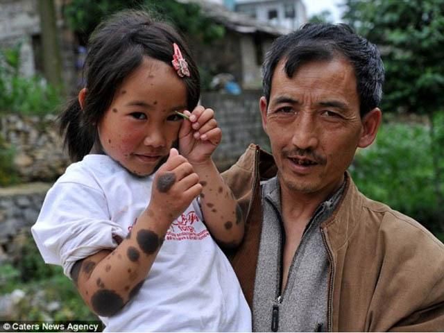 У Китаї живе дівчинка-"перевертень"