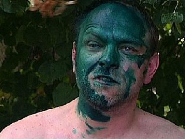 У Власенка діагностували опік правого ока У Власенка діагностували опік правого ока