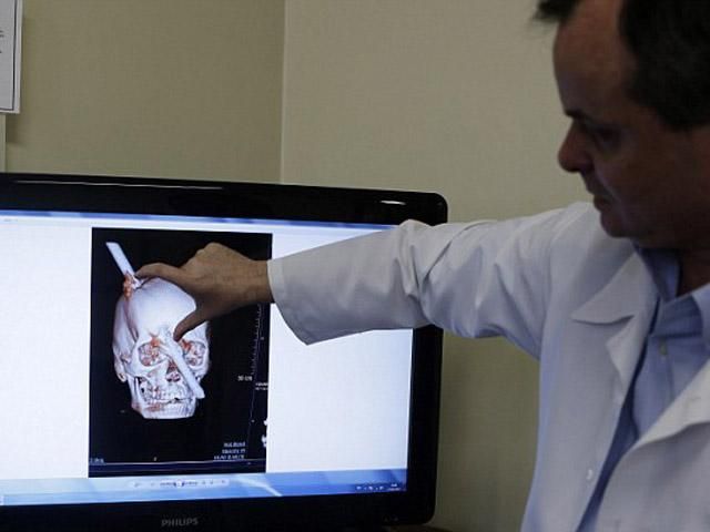 Бразилія: будівельник вижив після того, як металевий прут пронизав його голову Бразилія: будівельник вижив після того, як металевий прут пронизав його голову