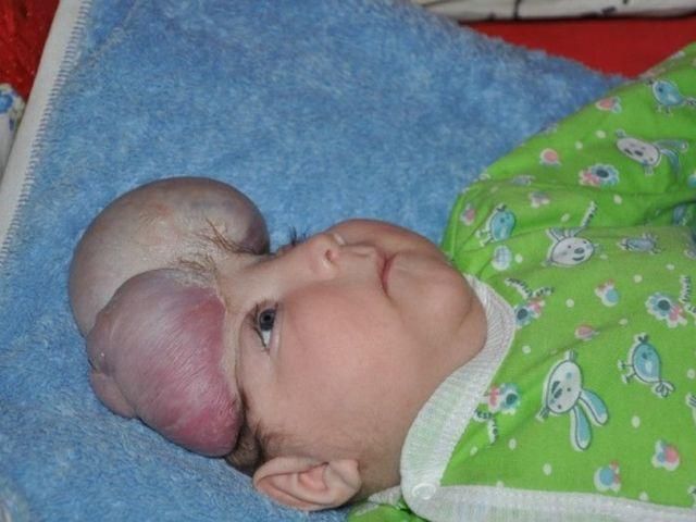 В Одессе живет мальчик без черепа (Фото) В Одессе живет мальчик без черепа (Фото)