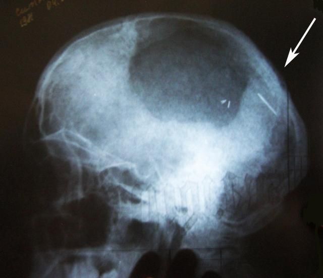 27-летняя китаянка узнала, что живет с иглой в голове