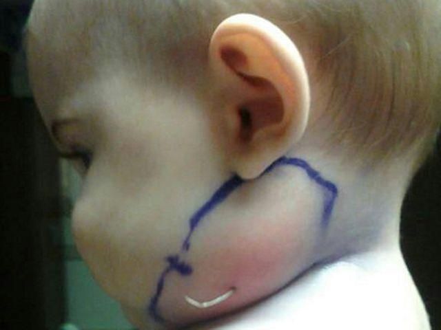 Через щеку семимесячной американки проросло птичье перо Через щеку семимесячной американки проросло птичье перо