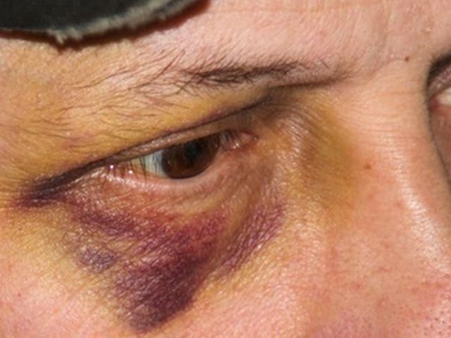 На Луганщині у барі побили депутата На Луганщині у барі побили депутата