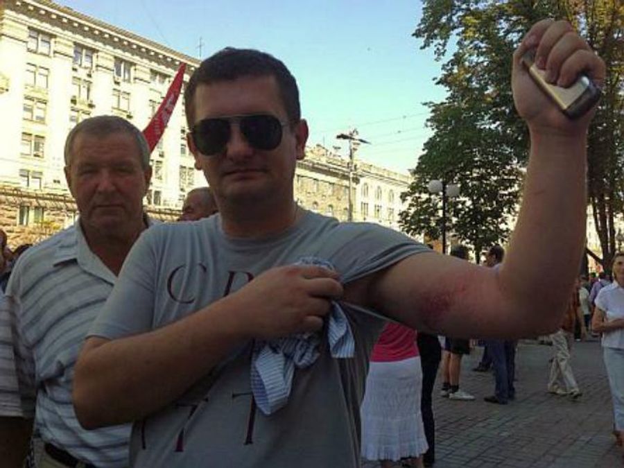 УДАРівця побили в Київраді: розірвали сорочку, на руках – гематоми і синці УДАРівця побили в Київраді: розірвали сорочку, на руках – гематоми і синці