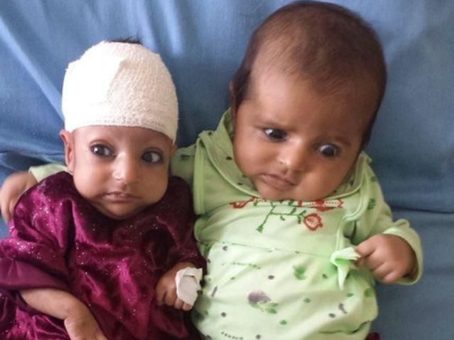 В Афганистане двуглавой девочке сделали успешную операцию (Фото)