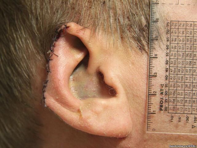 СМИ опубликовали фото травм Булатова СМИ опубликовали фото травм Булатова