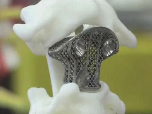 У Китаї імплантували хребець, виготовлений на 3D-принтері