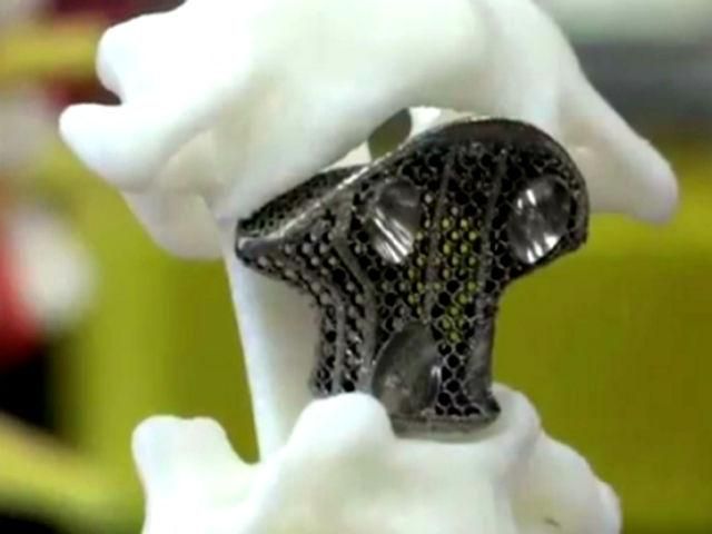 Здорове життя. Китайці першими імплантували хребець, роздрукований на 3D-принтері Здорове життя. Китайці першими імплантували хребець, роздрукований на 3D-принтері