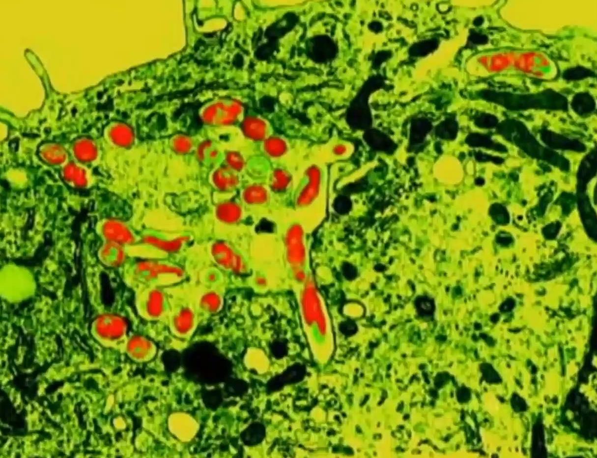 Факты о здоровье. Из-за Эбола люди забыли о туберкулезе Факты о здоровье. Из-за Эбола люди забыли о туберкулезе