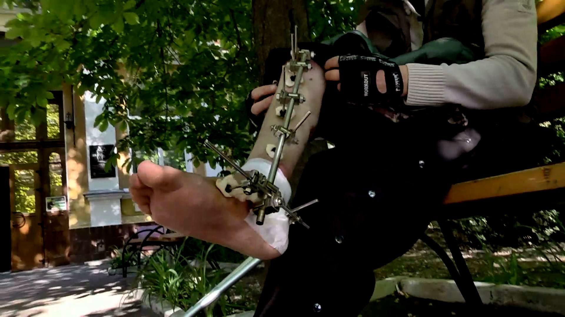 Почему чиновники не дают раненым бойцам лечиться за границей Почему чиновники не дают раненым бойцам лечиться за границей