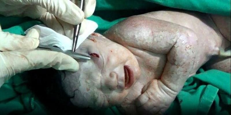 Дівчинка із осколком снаряду в голові народилась у Сирії (18+) Дівчинка із осколком снаряду в голові народилась у Сирії (18+)