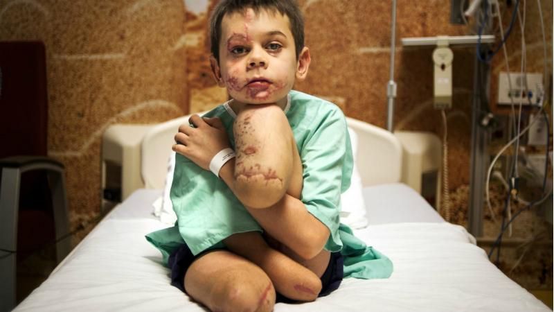 Фото скаліченого на Донбасі хлопчика перемогло у міжнародному конкурсі (18+) Фото скаліченого на Донбасі хлопчика перемогло у міжнародному конкурсі (18+)