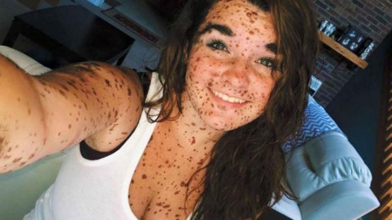 Їхні історії вражають: дівчата з особливою зовнішністю, що зробили з недоліків перевагу Їхні історії вражають: дівчата з особливою зовнішністю, що зробили з недоліків перевагу