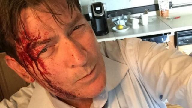 Окровавленный Чарли Шин серьезно пострадал из-за лекарства Окровавленный Чарли Шин серьезно пострадал из-за лекарства