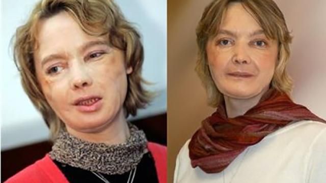 Померла жінка, який першій в світі пересадили обличчя Померла жінка, який першій в світі пересадили обличчя