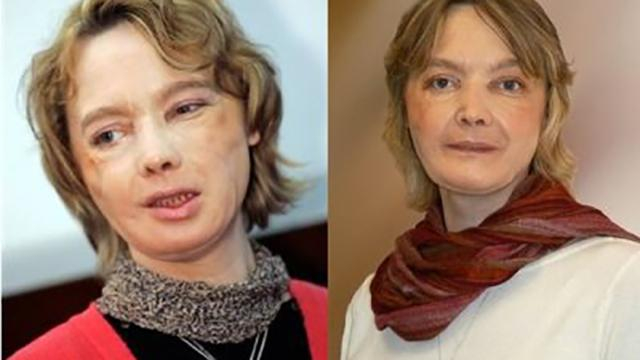 Умерла женщина, которой первой в мире пересадили лицо