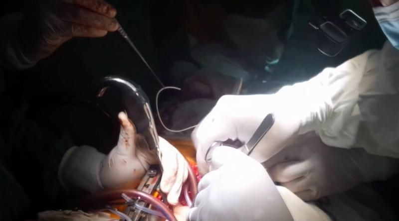 Чтобы спасти военного, врачи остановили его сердце на 23 минуты Чтобы спасти военного, врачи остановили его сердце на 23 минуты