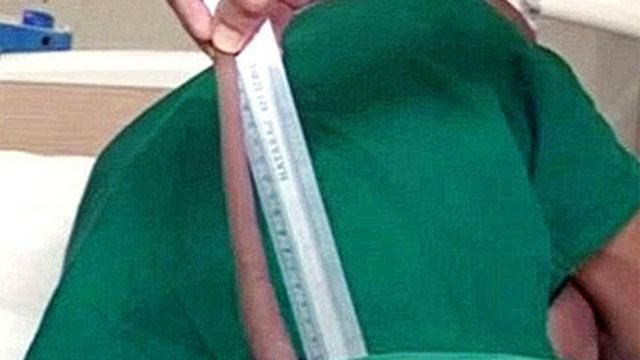 Молодому індусу провели операцію з ампутації хвоста
