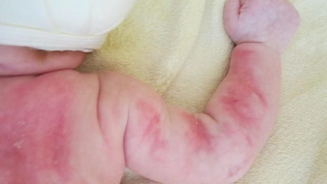 Двохлітній хлопчик отримав численні опіки через вибух самогонного апарату Двохлітній хлопчик отримав численні опіки через вибух самогонного апарату