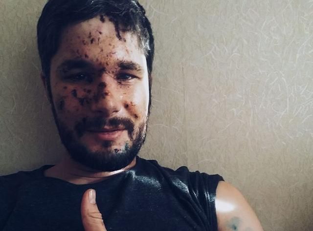 Раненый в Авдеевке журналист рассказал, как произошел злосчастный обстрел Раненый в Авдеевке журналист рассказал, как произошел злосчастный обстрел