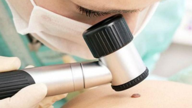 Как распознать меланому: советы медиков Как распознать меланому: советы медиков