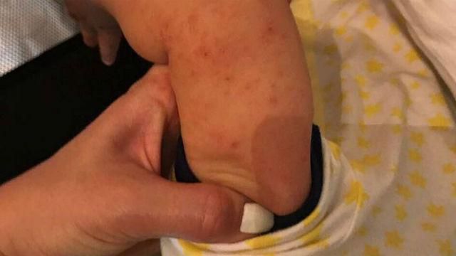 Вірус Коксакі в Туреччині підчепили українці: ситуація складна Вірус Коксакі в Туреччині підчепили українці: ситуація складна