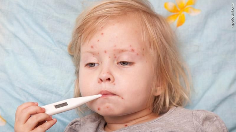 Корь в Украине: вспышку кори у детей зафиксировали в Луцке Корь в Украине: вспышку кори у детей зафиксировали в Луцке
