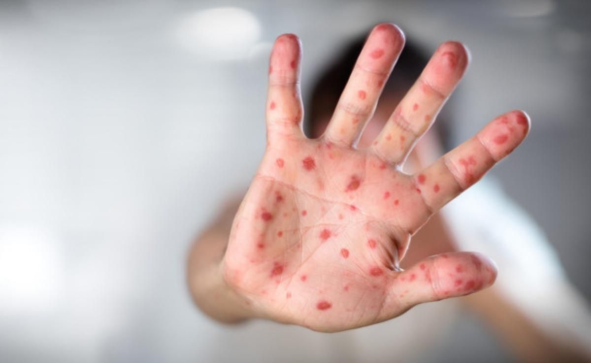 В 2018 році буде пік епідемії кору в Україні, – лікар-імунолог В 2018 році буде пік епідемії кору в Україні, – лікар-імунолог