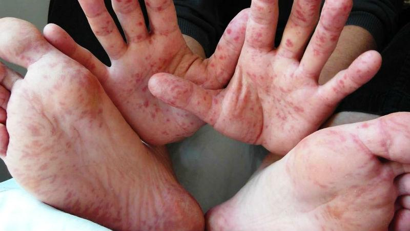 Корь в Украине: во Львове 9 взрослых попали в больницу 