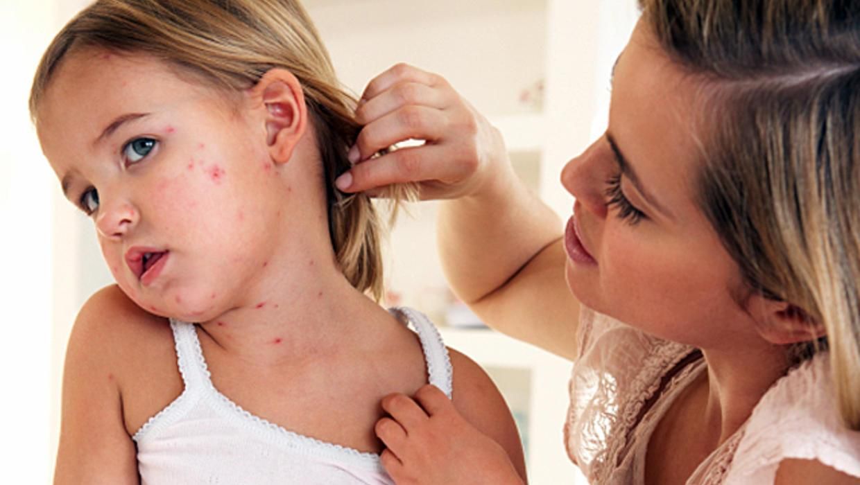 Названа область, до якої ще не дістався кір у 2018 році Названа область, до якої ще не дістався кір у 2018 році