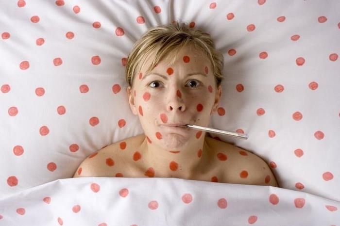 Вспышка кори в Польше: среди инфицированных – украинцы Вспышка кори в Польше: среди инфицированных – украинцы